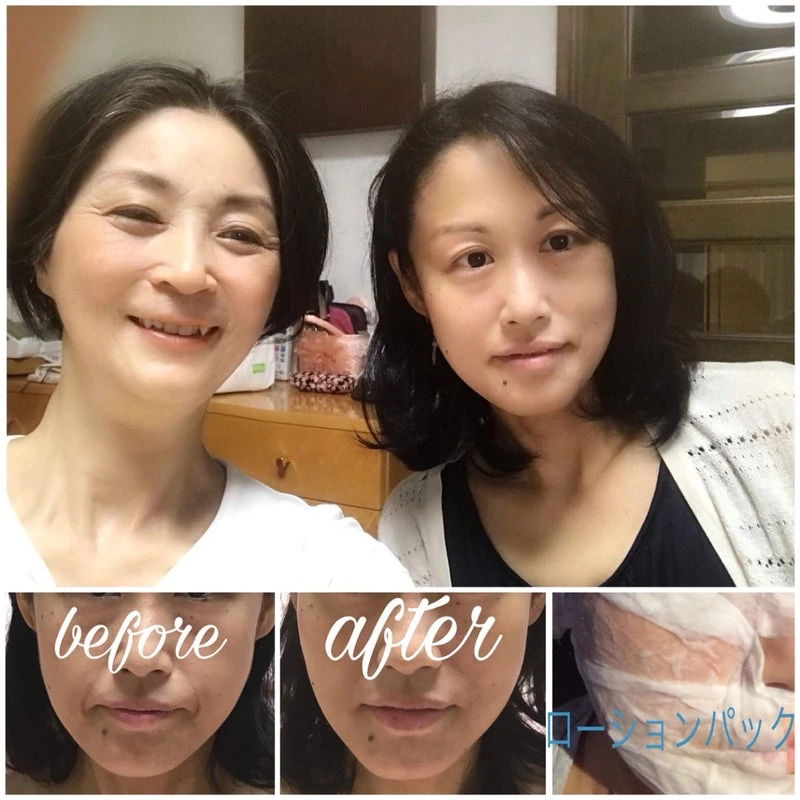 2018年にフェイシャルを受けた当時の記録写真